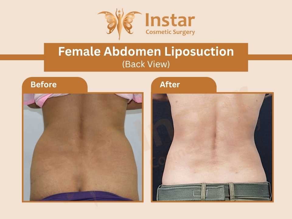 Female Abdomen Liposuction (Back View)-1